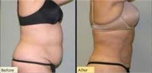 before and after3