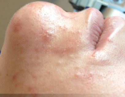 Before Hydrafacial MD