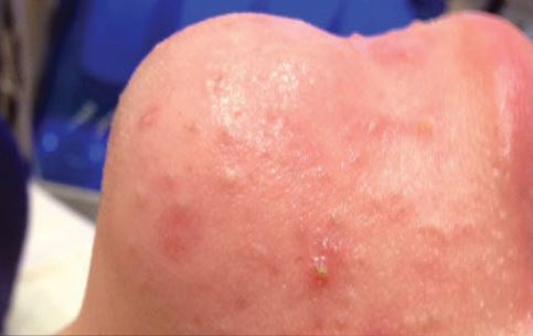 Before Hydrafacial MD